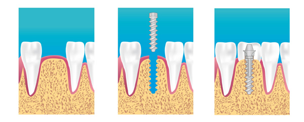 implant dentaire aix en provence